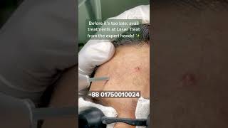 Acne Treatment  Dhaka Dermatology Institute  LaserTreat [upl. by Valentin]