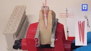 Endodontic treatment of the single rooted tooth Part 6 Obturation [upl. by Aileen34]