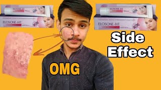 Elosone ht Cream  Uses Side effectsReviews Composition In Hindi [upl. by Ecyaj]