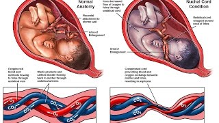 Nuchal Cords Fetal Oxygen Deprivation and Birth Injury [upl. by Leuas]