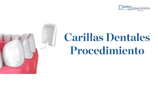 Carillas dentales procedimiento  Doctores Especialistas [upl. by Nosirb]