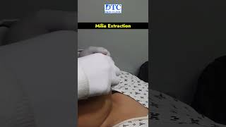 Milia Extraction Procedure at Chin  DTC Skin Clinic [upl. by Ahselet]