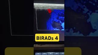 birads breastcancer breast ultrasonography female bass remix radiological radiology [upl. by Prady191]