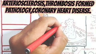 ArteriosclerosisThrombosis Formed PathologyCoronary Heart Disease umerfarooqbiology7083 [upl. by Honorine]