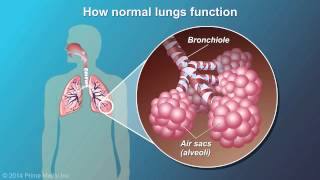 Understanding COPD [upl. by Phebe583]