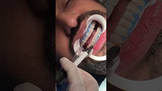 Teeth Whitening Procedure 😱🫣drrehanahmed dentistavenue teethwhitening teethwhitening teethcare [upl. by Joyann519]