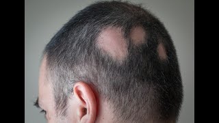 Alopecia areata Treatment  Intralesional Corticosteroid InjectionBy Dr sunny Rajput [upl. by Aroc]