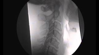 Video Fluoroscopy  Cervical Spine  SMVFRFC71712wmv [upl. by Wehtam]