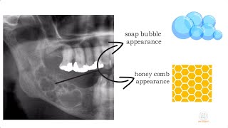 Ameloblastoma part 1 [upl. by Isidro]