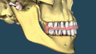 Avance mandibular  Ortodoncia [upl. by Ennaeiluj]