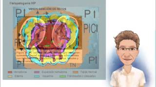 HEMORRAGIA INTRACEREBRAL FISIOPATOLOGÍA [upl. by Dag]