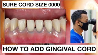 How to placement Gingival Cord for Veneers Preparation  General Dentist Griya RR [upl. by Lledroc650]