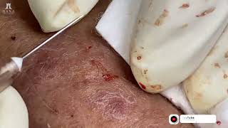 Big Cystic Acne Blackheads Extraction Blackheads amp Milia Whiteheads Removal Pimple Popping 2024 [upl. by Naved]