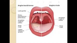 Les angine aigues Pr kharoubi meilleure explication 🤩🤩  ORL  ECN [upl. by Nillek311]