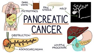 Understanding Pancreatic Cancer [upl. by Lemuel]