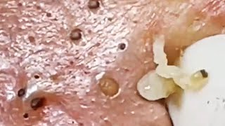 Deep blackhead extraction Cystic acne amp pimple popping 77 [upl. by Nnylirak]