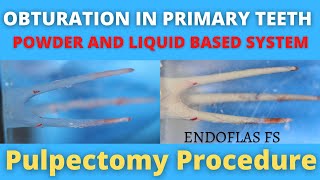 Obturation in Primary Teeth  Powder and Liquid Based Material  Pulpectomy Procedure [upl. by Leibrag]