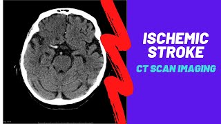 Imaging of Ischemic Stroke For Medical students residents and clinicians [upl. by O'Grady]