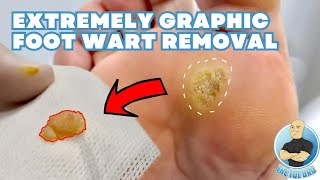 EXTREMELY GRAPHIC FOOT WART REMOVAL 5 YEARS OF UNSUCCESSFUL TREATMENT [upl. by Curran437]