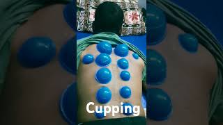 Back cupping cuppingtherapy cupping motivation rehabilitation exercise doctor physicaltherapy [upl. by Pallaton750]