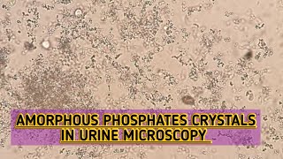 Amorphous Phosphates crystals seen in urine microscopyAlkaline crystalsRoutine urine examination [upl. by Penney]