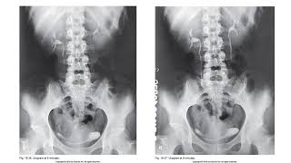 Intravenous Urography [upl. by Camilla]