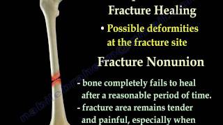 Fracture Healing Part 1  Everything You Need To Know  Dr Nabil Ebraheim [upl. by Westfall]