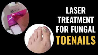 Lunula Laser  Fungal Infection Removal With Lasers [upl. by Esiuqram862]