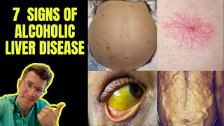 Doctor outlines 7 signs of Alcoholic Liver Disease ascites Caput Medusae jaundice amp more [upl. by Aaren86]