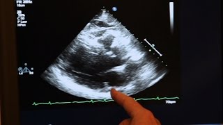 Echocardiogram Demonstration [upl. by Charline149]