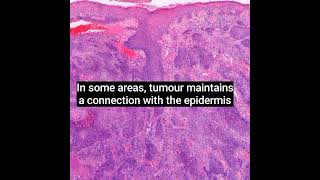 Histopathology of Porocarcinoma dermatopathology dermpath shorts [upl. by Arymas223]