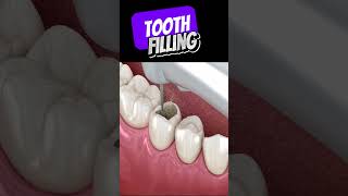 How is tooth filling done [upl. by Pinchas506]