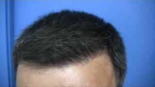 Hair transplant by Dr Wong  2811 Grafts  1 Session [upl. by Alludba]