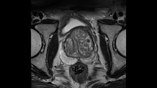 Introduction to Prostate MRI and PIRADS Approach and Principles [upl. by Lehcin851]