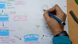 Atherosclerosis  Cause  pathology  Coronary Artery Disease in Hindi [upl. by Adamis]