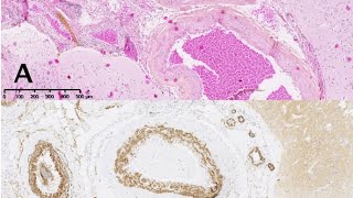 vascular malformation in skin histopathology Slides [upl. by Sirdi443]