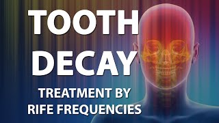 Tooth Decay  RIFE Frequencies Treatment  Energy amp Quantum Medicine with Bioresonance [upl. by Laeahcim768]