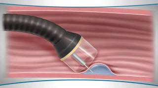 Learn About an Endoscopic Mucosal Resection [upl. by Osswald]