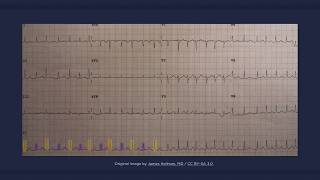 Electrical Alternans ECG [upl. by Yrral]