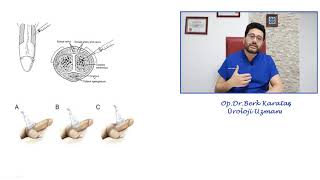 Penil Renkli Doppler Ultrasonografi Nedir ve Kimlere Yapılmalıdır [upl. by Elfreda]