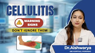 Cellulitis Alert  Dont Ignore These Cellulitis Symptoms  Dr Aishwarya  KBK Hospitals [upl. by Nire155]