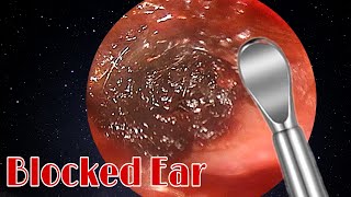 BIGGEST Ear Wax Difficult Removal  EP3  Doctor Anh [upl. by Zetnas]