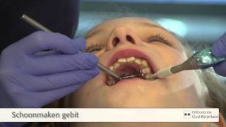 Plaatsen van een Expander Spin beugel  Orthodontie OudBeijerland [upl. by Eglanteen155]