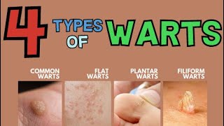 THE 4 MAIN TYPES OF WARTS [upl. by Lurie]