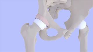 Femoroacetabular Impingement Syndrome [upl. by Amerigo]