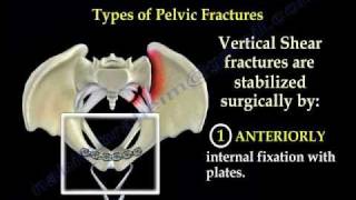 Pelvic Fracture Overview  Everything You Need To Know  Dr Nabil Ebraheim [upl. by Anasus658]