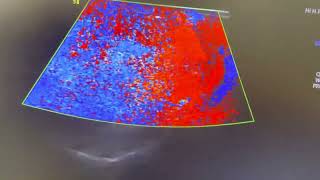 Ultrasoubd of acute epididymo orchitis [upl. by Hastie]