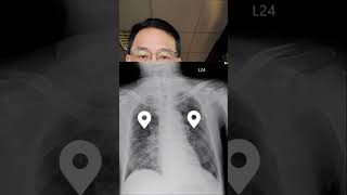 X光片判讀cystic lung ds [upl. by Quitt]