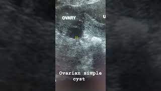 ovary simplecyst ultrasound education study pelvic sonography ultrasound pelvis anatomy cyst [upl. by Nwahsirhc]