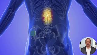 What is Spinal Cord Stimulator Implantation [upl. by Aleece16]